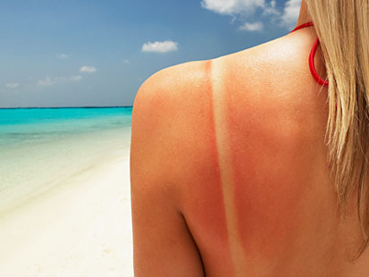 Homemade Sunburn Remedy