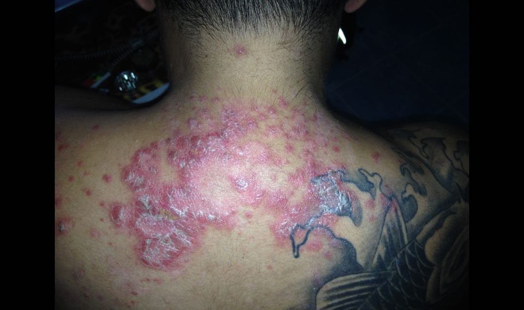 How I Beat Psoriasis