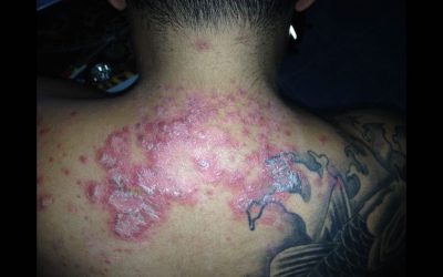 How I Beat Psoriasis