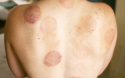Cupping in Phuket: Why Everyone Should Try it