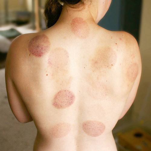 Cupping in Phuket: Why Everyone Should Try it